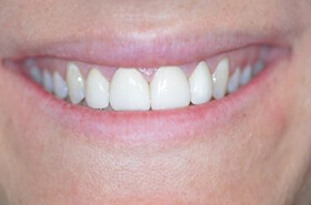Cosmetic Dentistry After