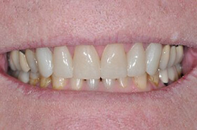 Dental Fear Teeth After