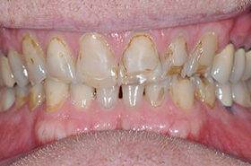Restorative before