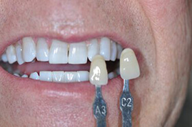 Whitening Treatment