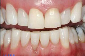 Smile Whitening After