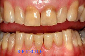 Smile Whitening Before