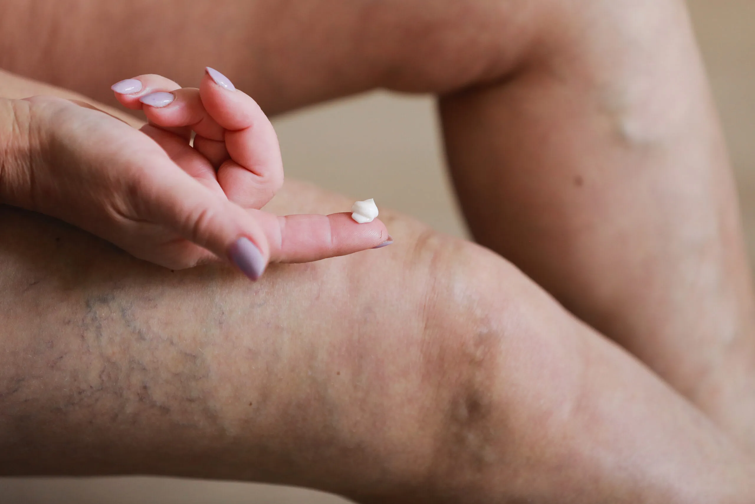 Varicose Vein Medication - Beltline Health & Weight Loss Solutions