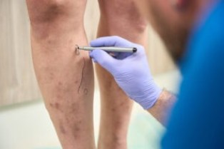 6 Stages of Venous Insufficiency - Beltline Health