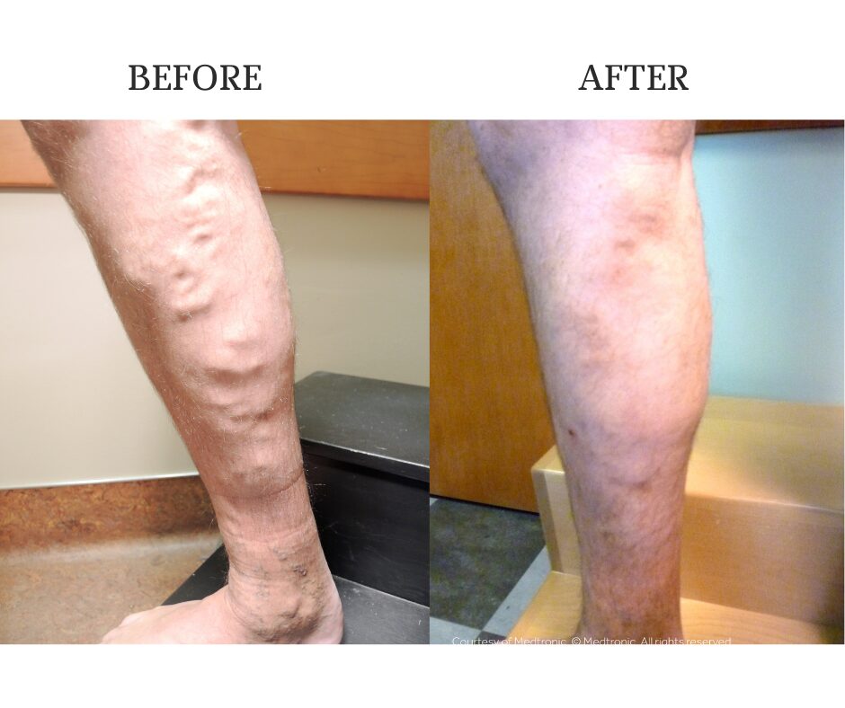 Vein Therapy Treatment - Dr. Procter