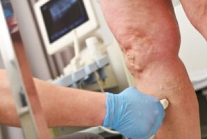 Signs and Symptoms of Venous Insufficiency - Beltline Health
