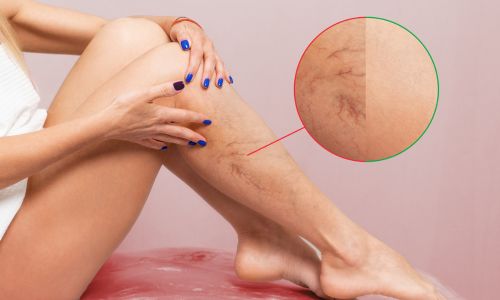 vein disease