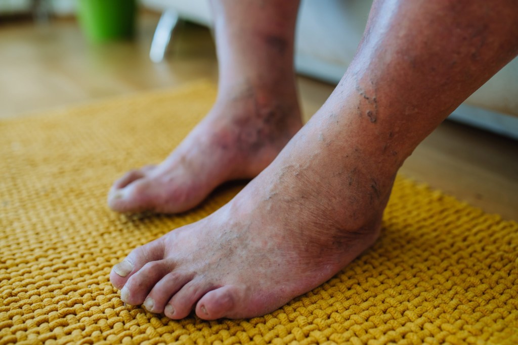 venous insufficiency Beltline Health & Weight Loss Solutions