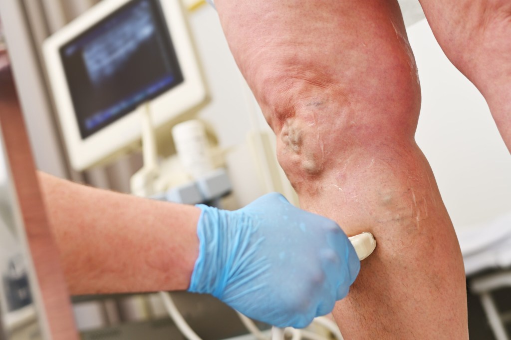 Treatment of Chronic Venous Insufficiency
