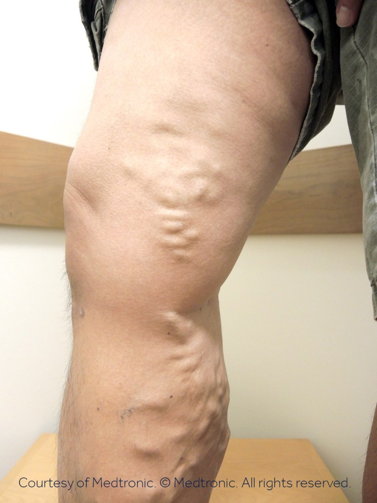 VenaSeal - Dr. Procter