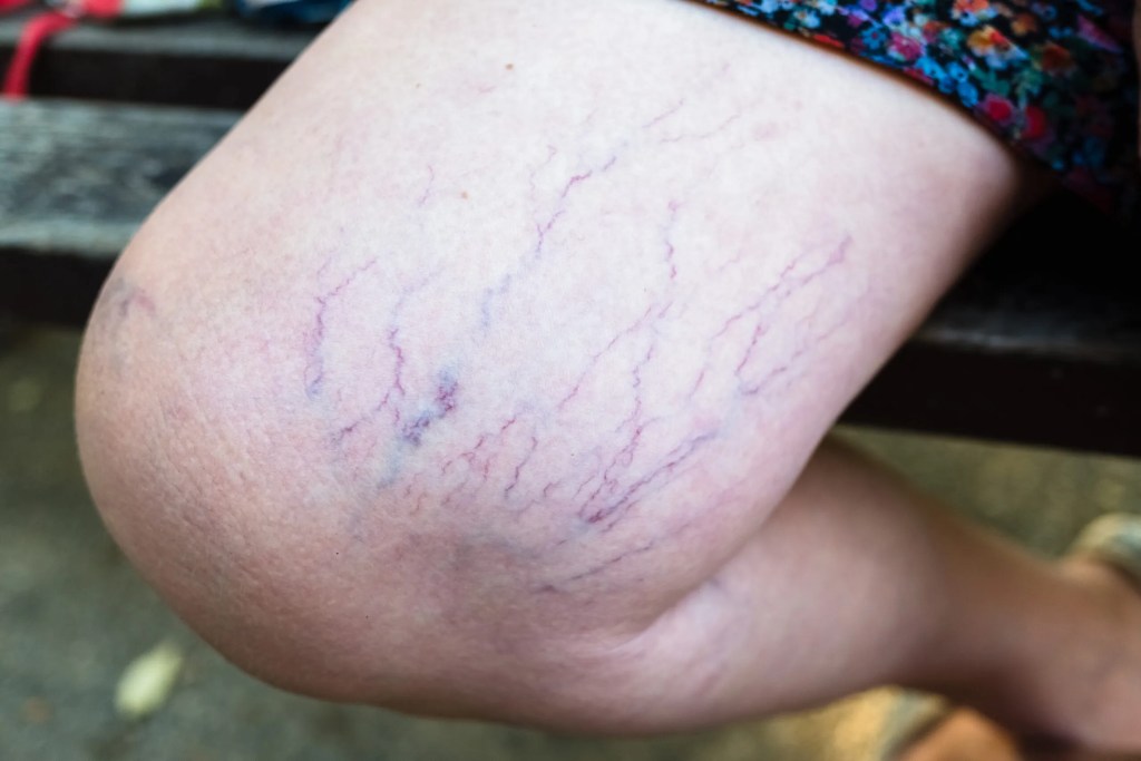 Varicose Vein Medication - Dr. Procter at Beltline Health & Weight Loss Solutions