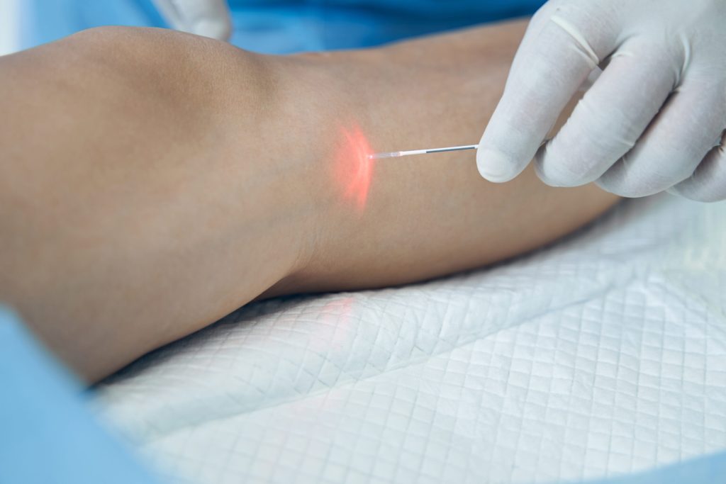 How to Restore Comfort & Confidence with Vein Care Beltline Health
