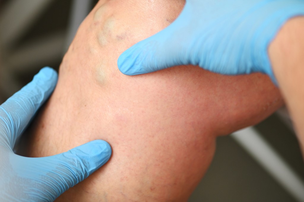 Management and Treatment Options for Early Stages