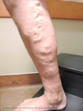 management of venous insufficiency