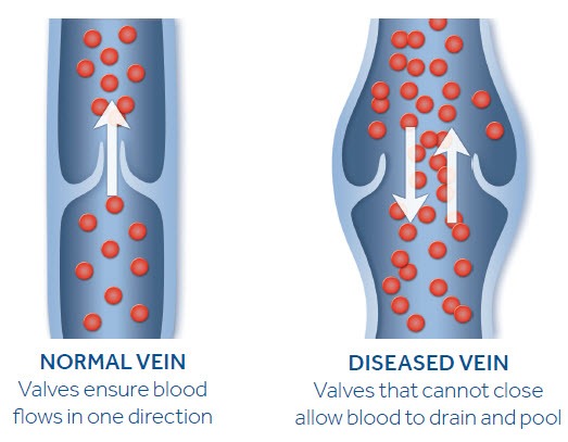 VenaSeal - Beltline Health & Weight Loss Solutions