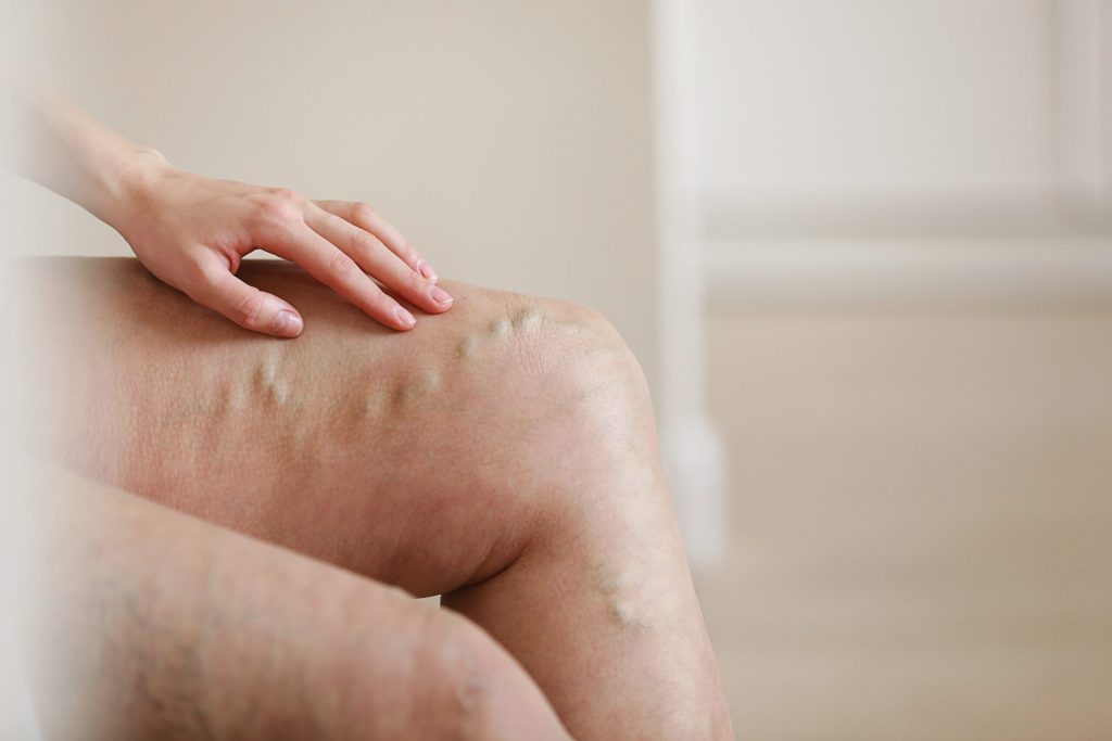 What is Venous Insufficiency - Dr. Procter