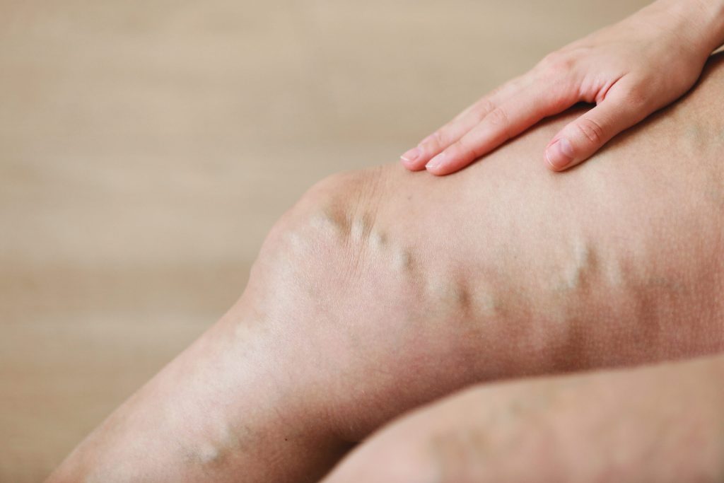 How to recognize early stages of venous insufficiency?
