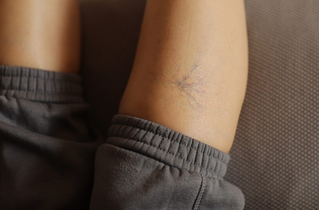 Varicose Vein Medication - Dr. Procter