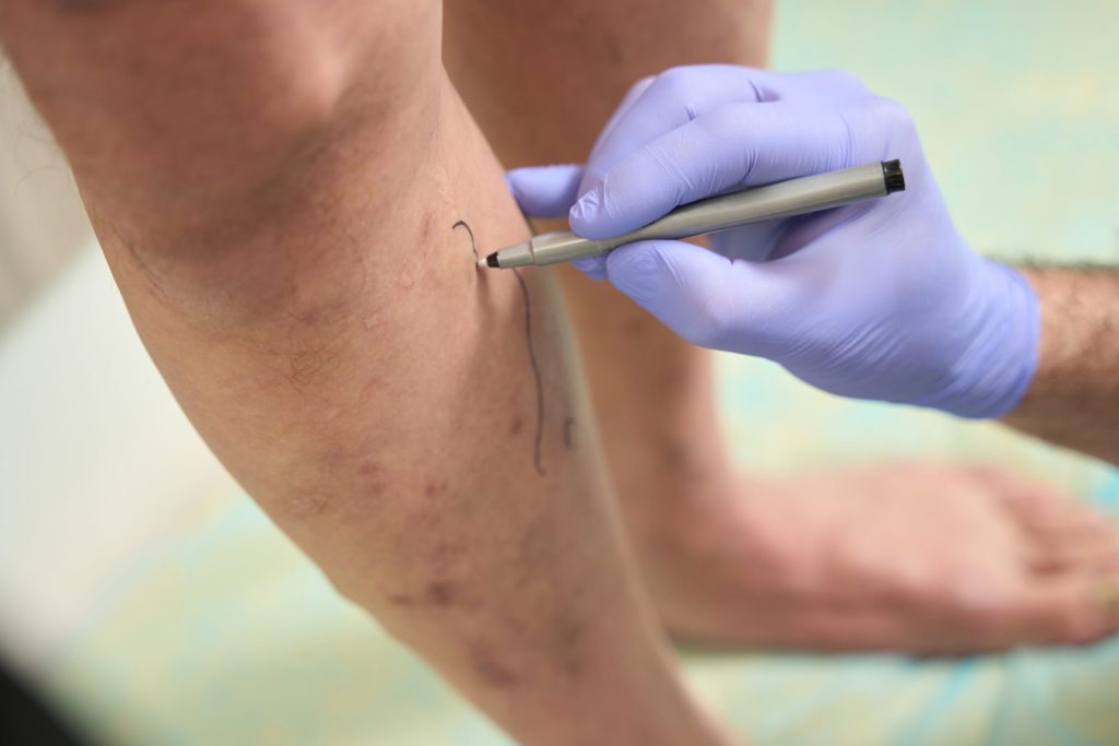 What is Venous Insufficiency - Beltline Health & Weight Loss Solutions