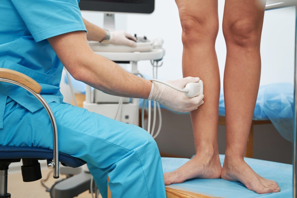 How to Combat Varicose Veins Beltline Health Vein Clinic