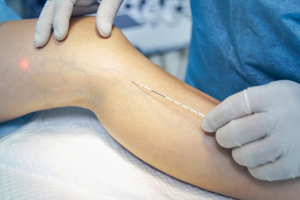 Reversing Venous Insufficiency - Beltline Health
