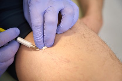 Asclera treatment