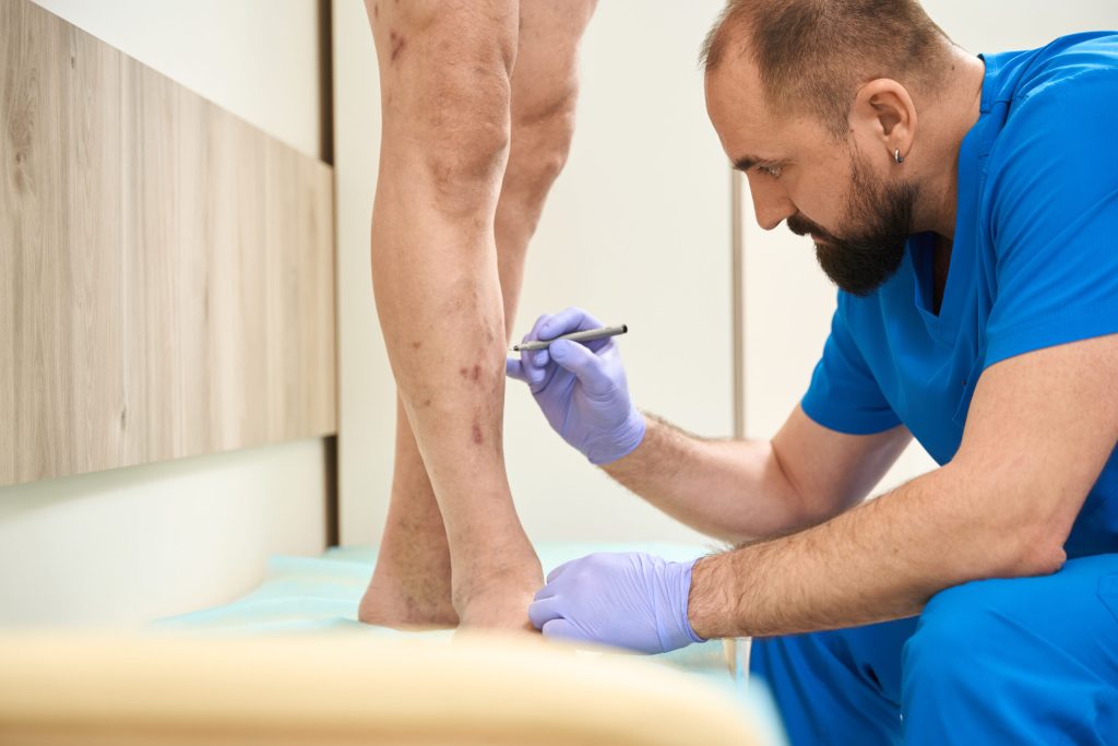 Radiofrequency Ablation of Varicose Vein - Beltline Health
