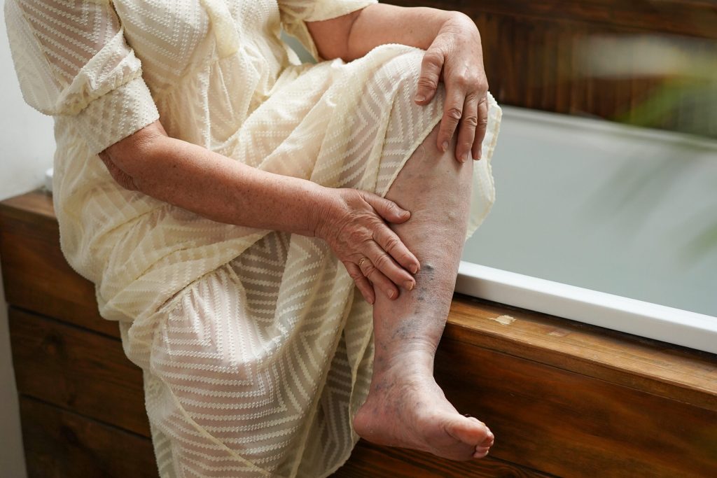 Chronic Venous Insufficiency
