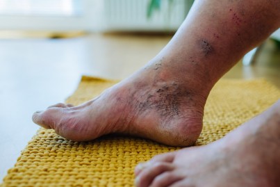 What vein disease looks like