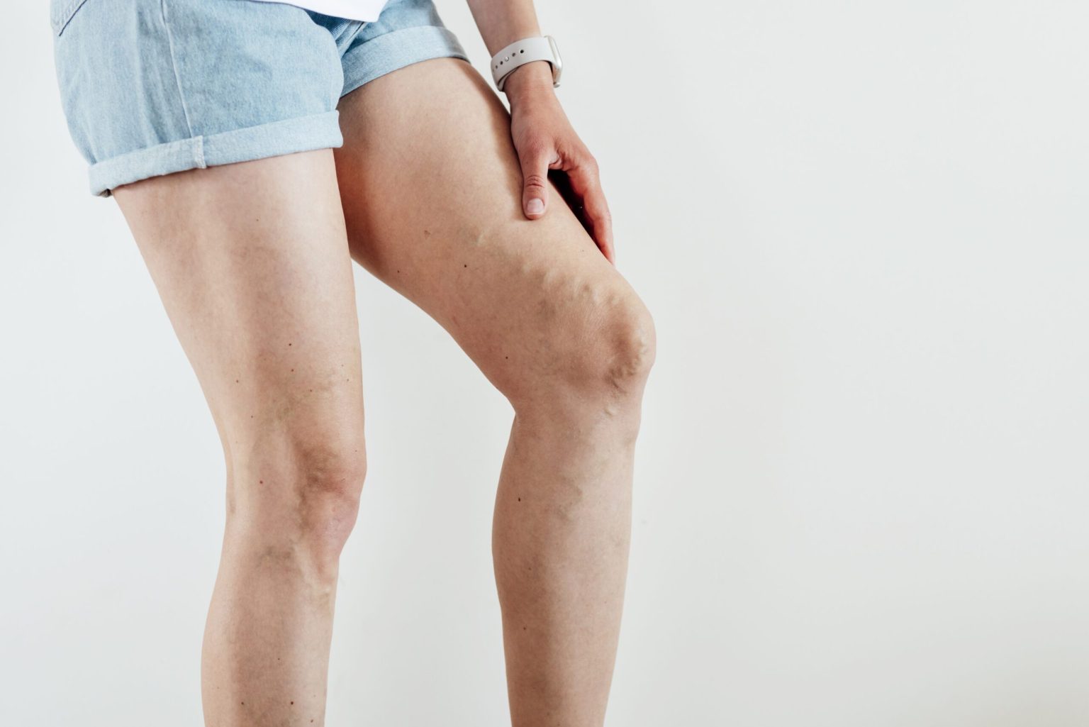 what is chronic venous insufficiency? - Beltline Health