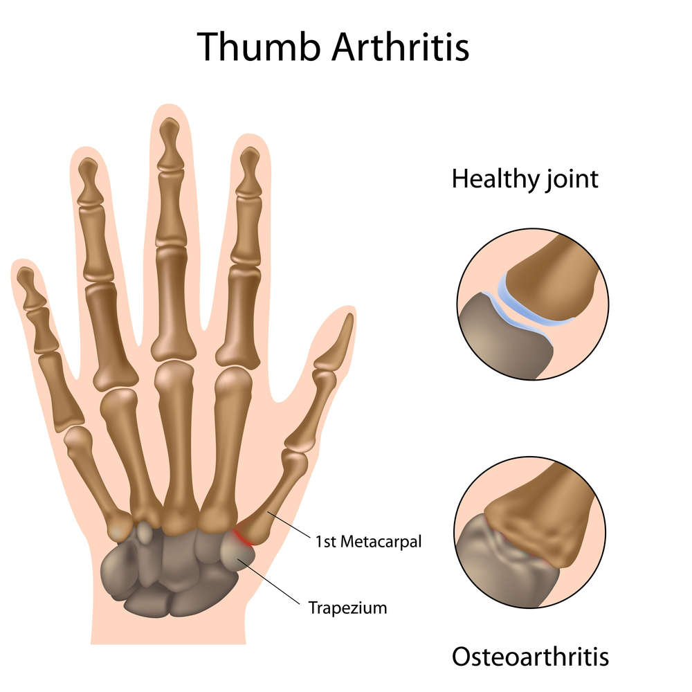 Illustration of hand arthritis vs. a healthy joint