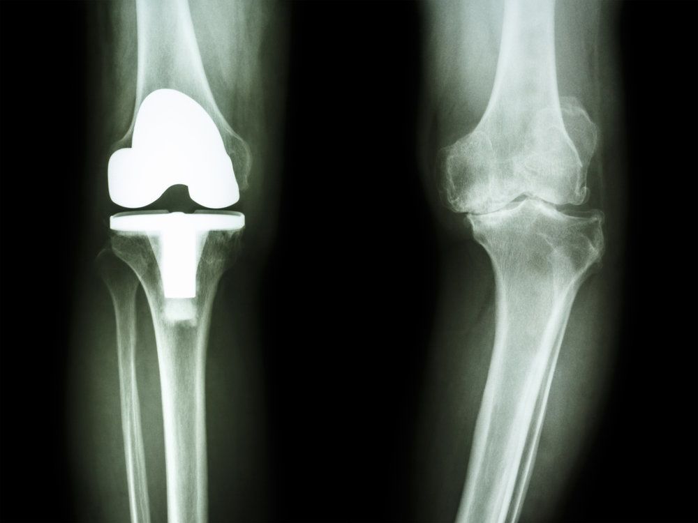 x-ray image of a knee before and after joint replacement