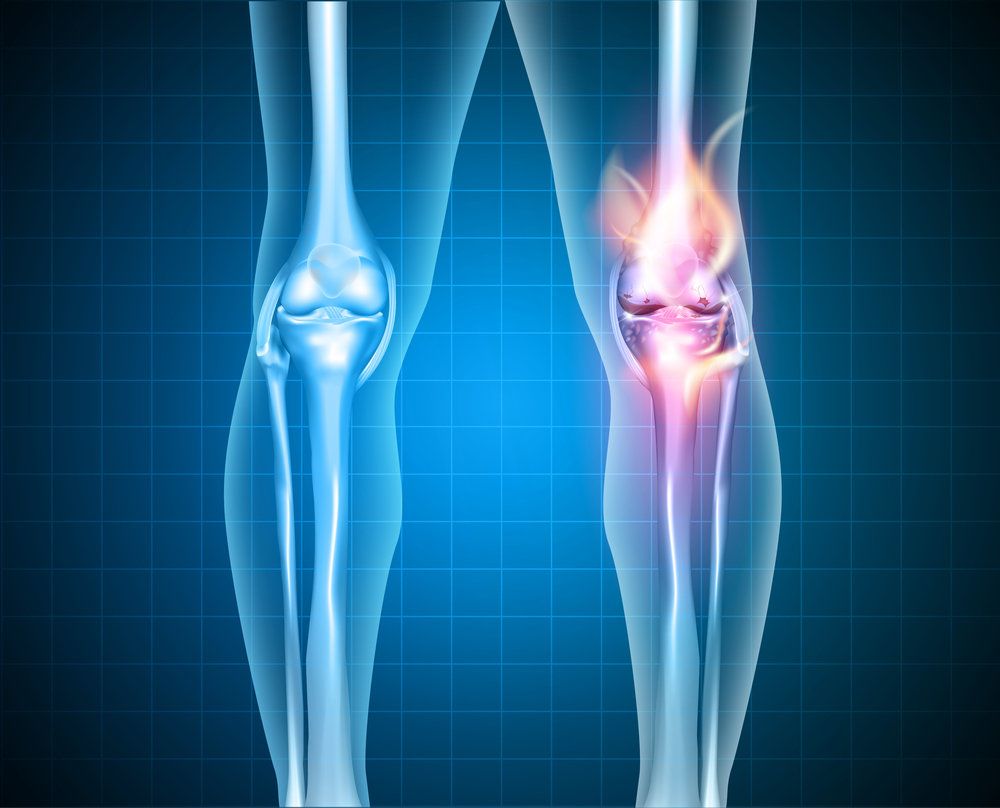 Digital illustration of knee pain